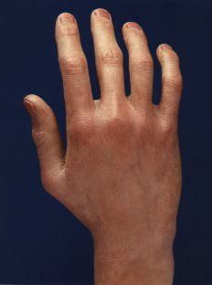 Marfan Syndrome hand